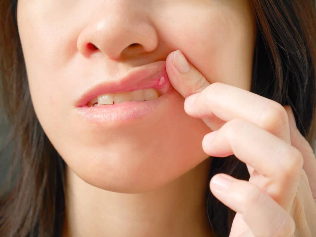 Treating Canker Sores & Cold Sores At Home Remedies, Over The Counter and Prescription Remedies